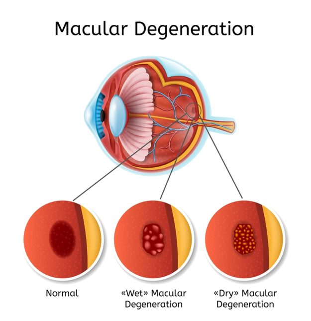 Macular Degeneration Vector Medical Diagram With Eye Anatomy Int